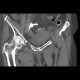 Rectovaginal fistula: CT - Computed tomography
